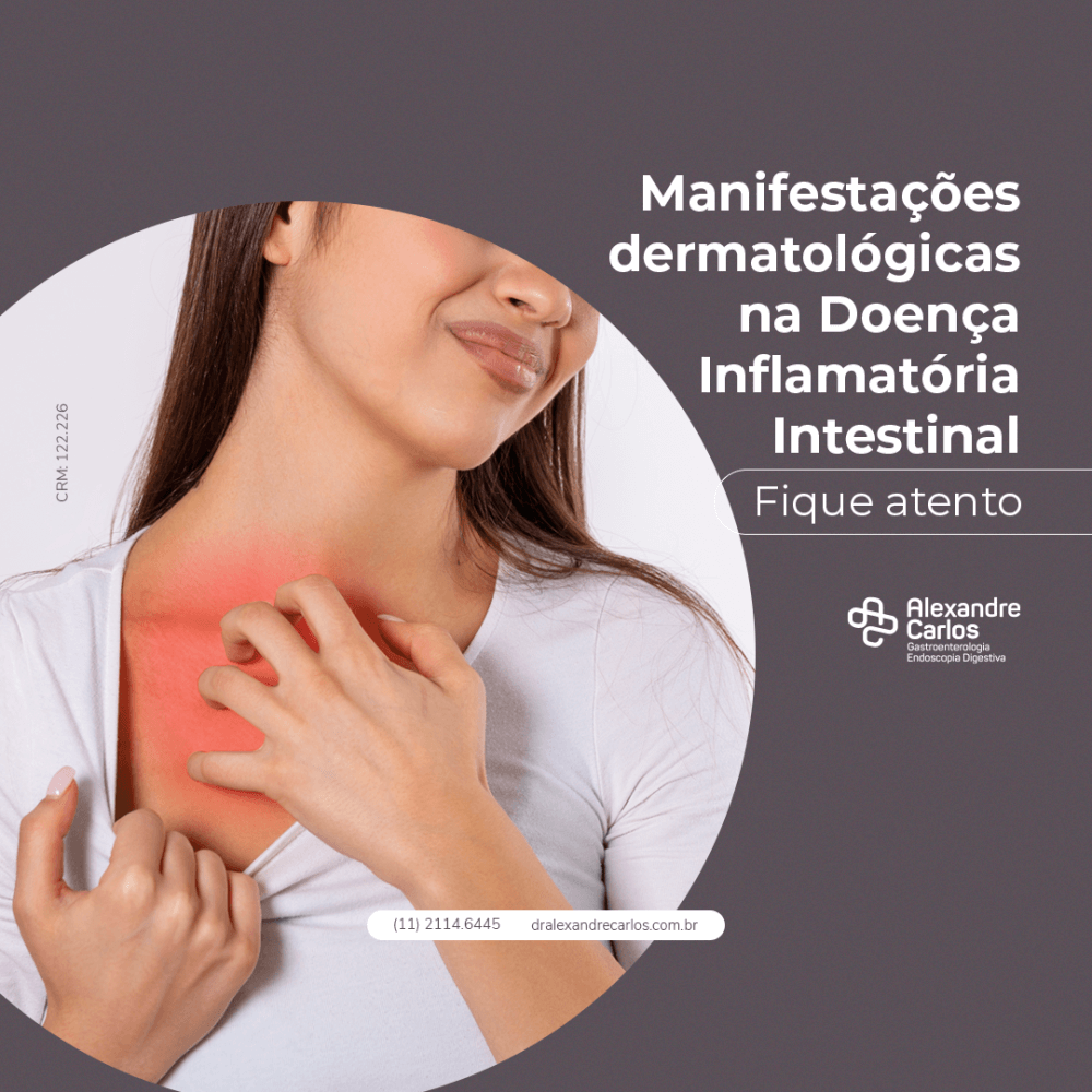 Manifesta Es Dermatol Gicas Na Doen A Inflamat Ria Intestinal Fique